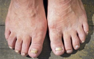 Micosi ai piedi: come prevenirla e rimedi naturali - ricette-vegane-dal-web - micosi ai piedi 400x250 1 - micosi ai piedi 400x250 1 - Micosi ai piedi: come prevenirla e rimedi naturali - ricette-vegane-dal-web-